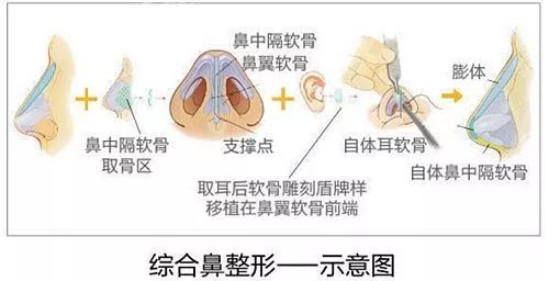 鼻综合整形