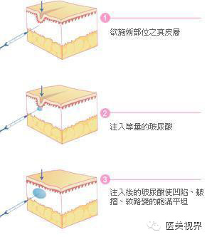 玻尿酸